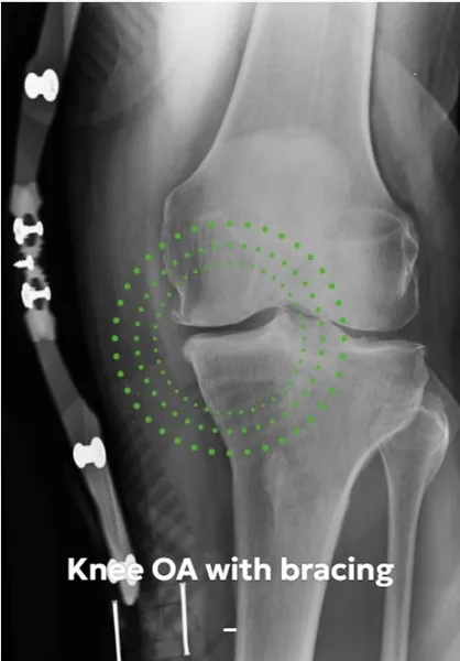 Knee OA with bracing