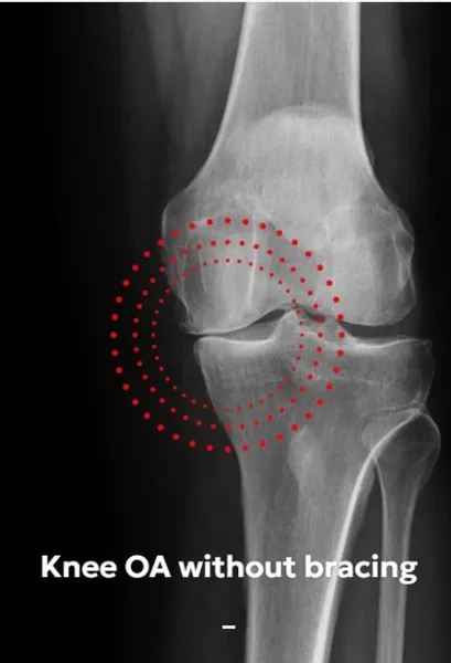 Knee OA without bracing