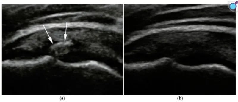 Before and after ultrasound showing elimination of calcification