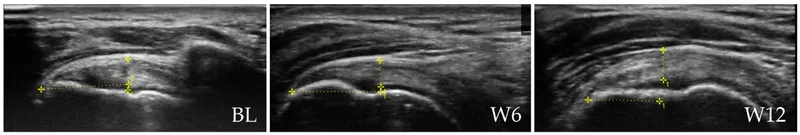 Ultrasound images showing improvement after shockwave therapy